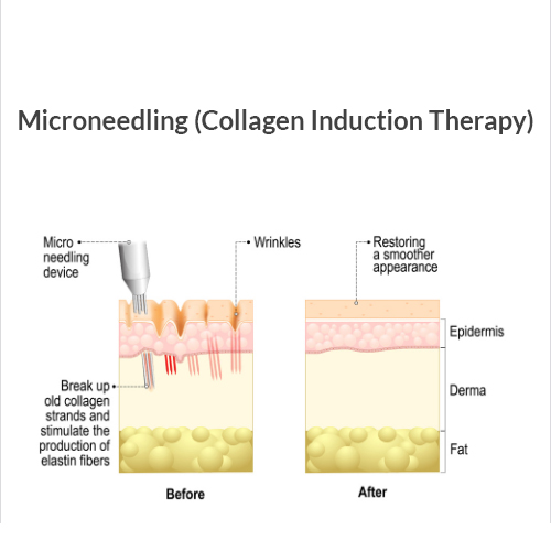 Microneedling